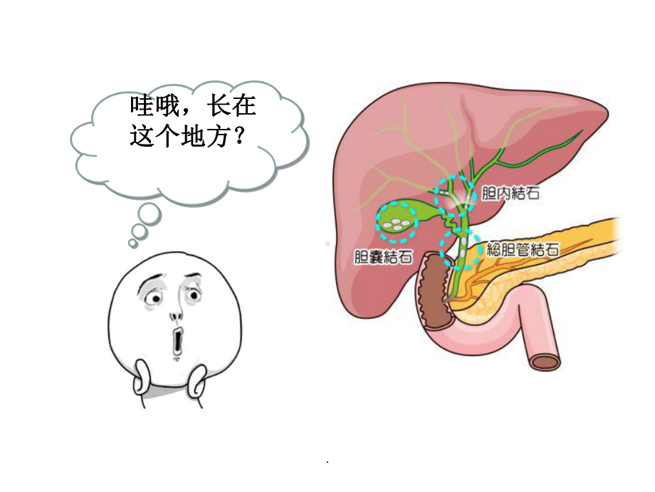 胆囊结石科普完整ppt课件.ppt_第3页