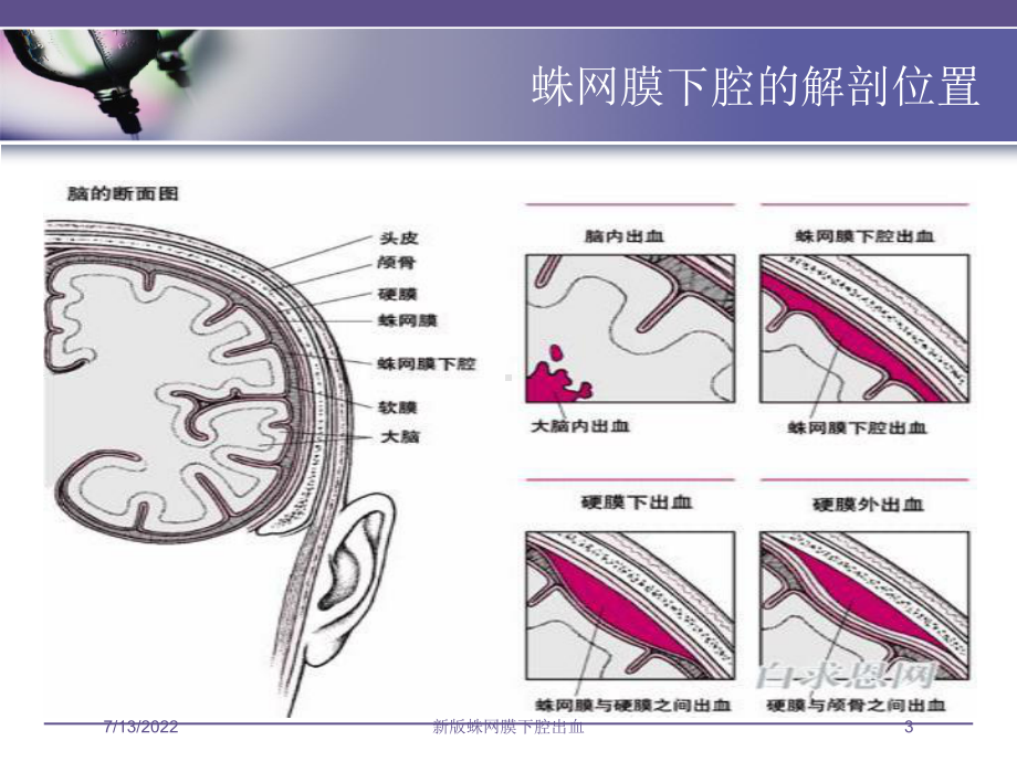 新版蛛网膜下腔出血培训课件.ppt_第3页