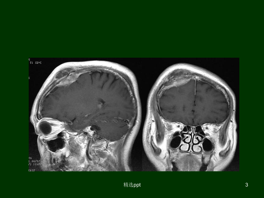 颅内淋巴瘤CTMR诊断与鉴别课件.ppt_第3页