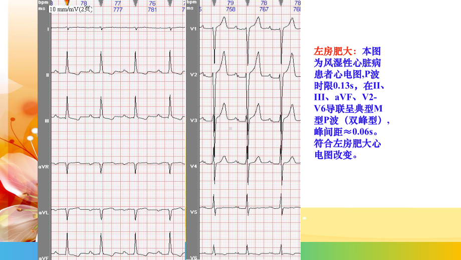 房室肥大心电图图解-ppt课件.ppt_第3页