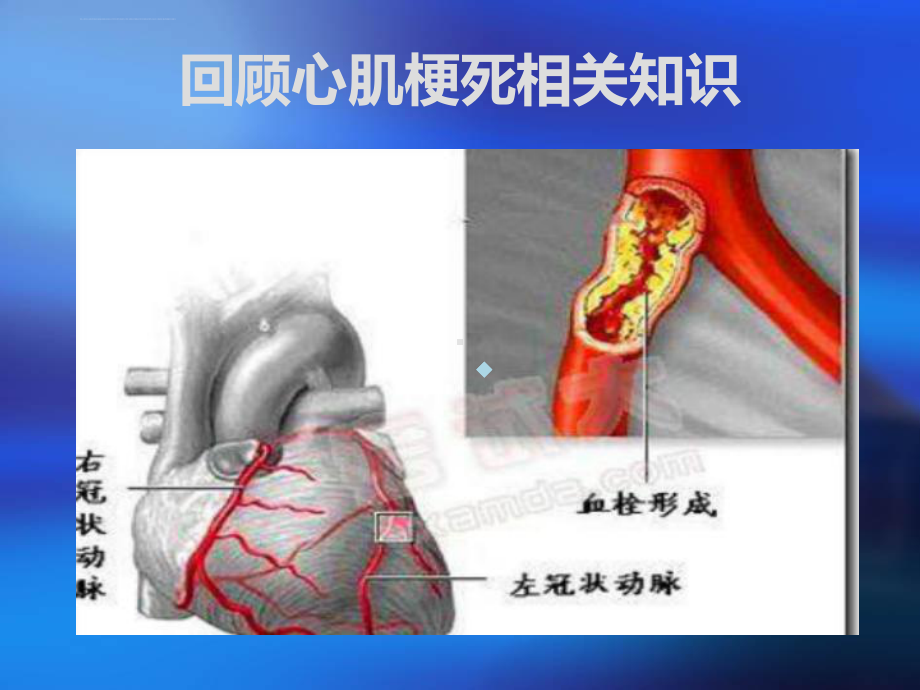 心肌梗塞护理查房ppt课件2.ppt_第2页