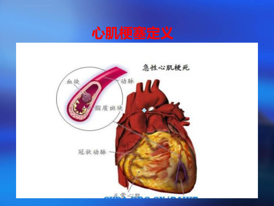 心肌梗塞护理查房ppt课件2.ppt_第3页