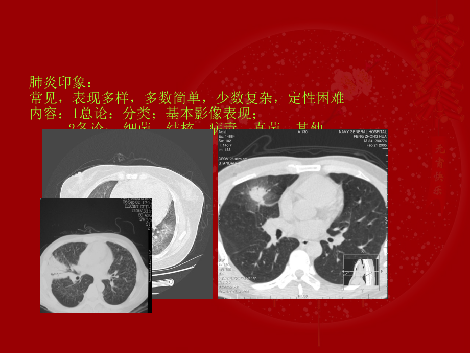 肺部炎性结节影像鉴别诊断-ppt课件.ppt_第2页