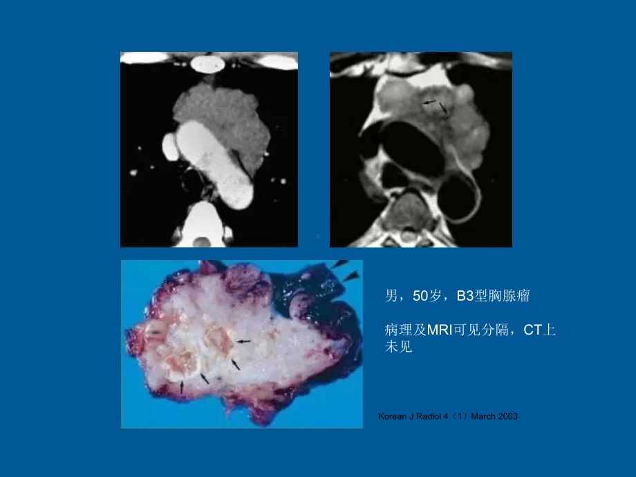 胸腺肿瘤影像诊断精品PPT课件.pptx_第3页