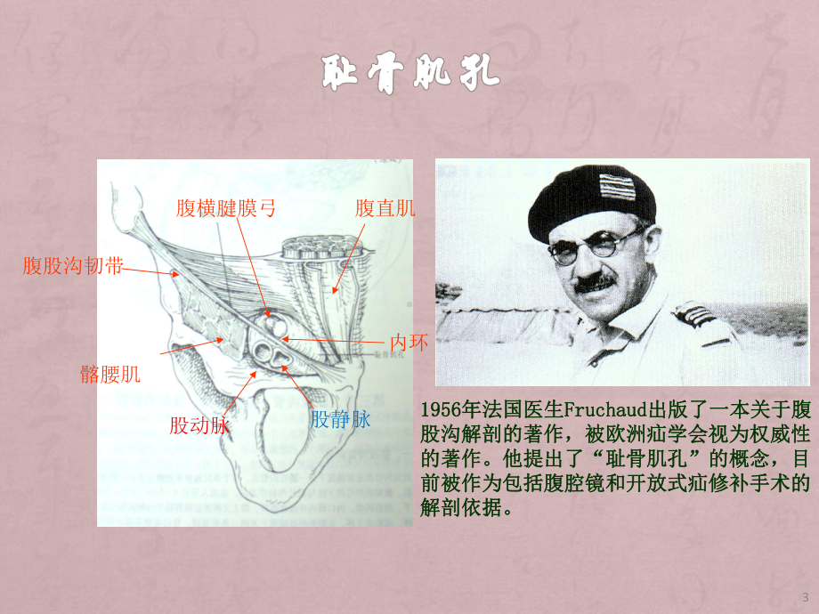 开放腹膜前间隙疝修补术PPT课件.ppt_第3页