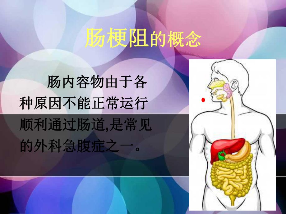 肠梗阻及其护理PPT课件.ppt_第3页