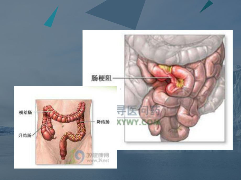 肠梗阻疑难病例讨论课件.ppt_第2页