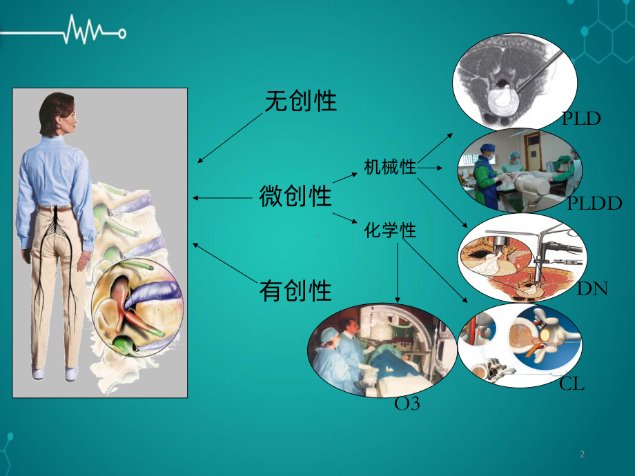 臭氧联合射频治疗腰椎间盘突出症PPT课件.ppt_第2页