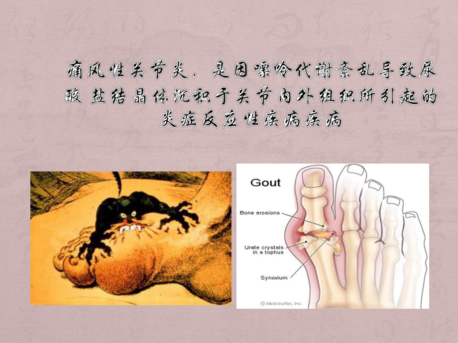 痛风性关节炎的诊断及治疗PPT精品医学课件.ppt_第3页