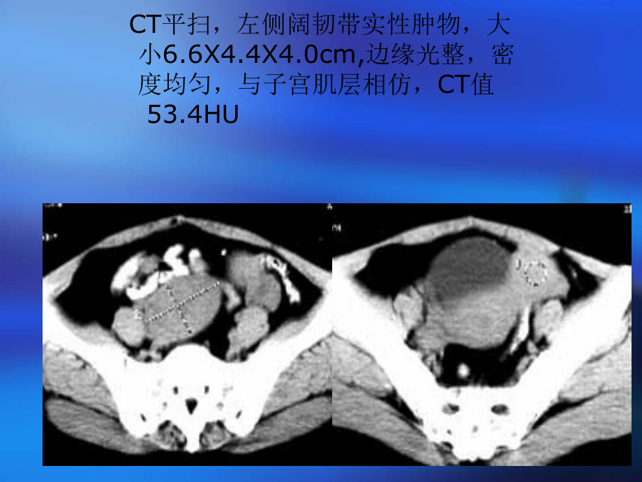 CT在女性生殖系统的应用课件.ppt_第3页