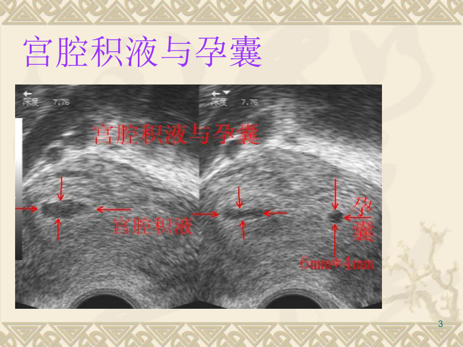 -产科超声图片集课件.ppt_第3页