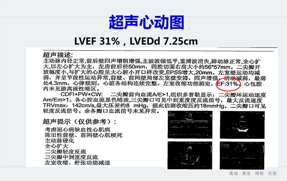 CABG+室壁瘤切除术后CRTD植入一例课件.pptx_第3页