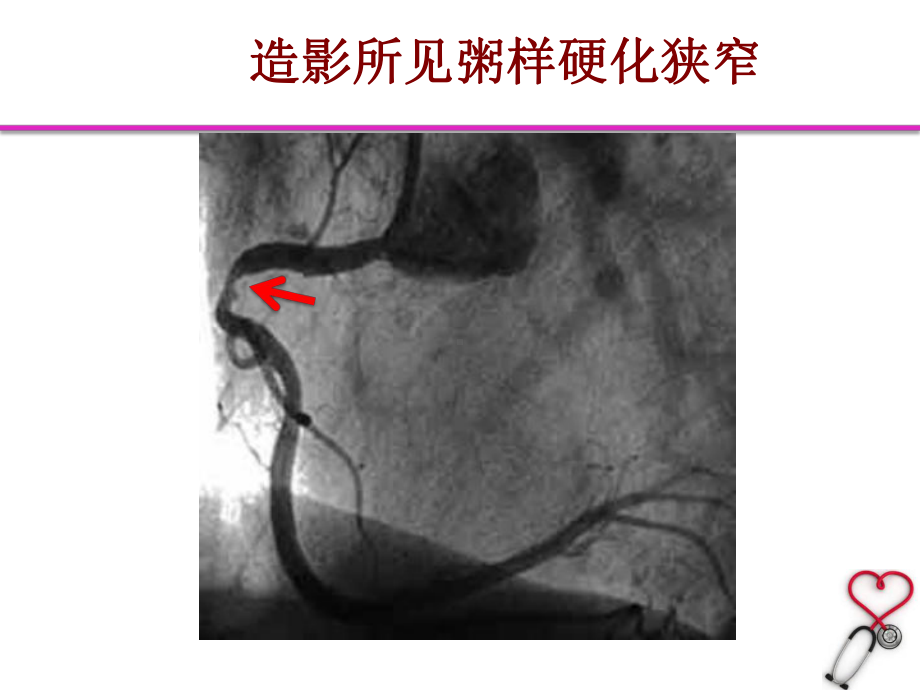 CMR在ACS患者中的应用课件.pptx_第3页