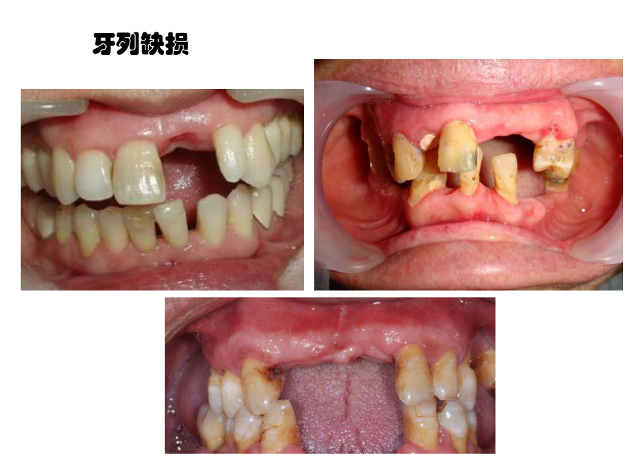 (口腔科学课件)2.2牙列缺损牙列缺失(讲课用).ppt_第3页