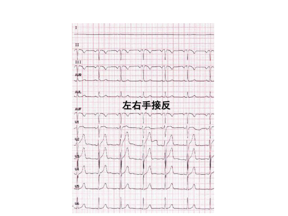 房室肥大心肌梗死课件.ppt_第1页