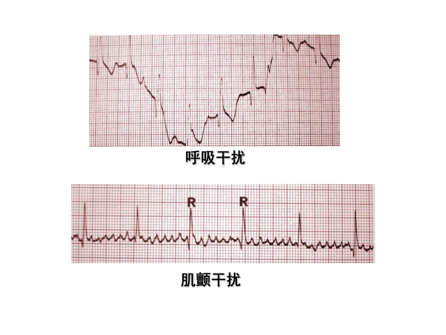 房室肥大心肌梗死课件.ppt_第2页