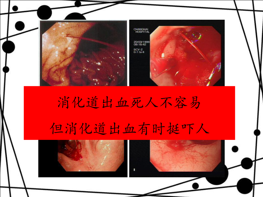 心血管科中消化道出血防治课件.ppt_第2页