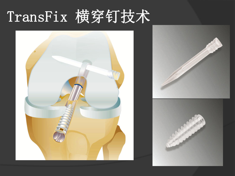 Transfix固定前交叉韧带课件.ppt_第2页