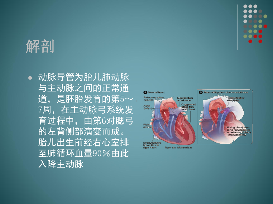 关注早产儿动脉导管未闭课件.ppt_第2页