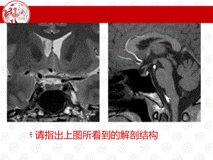 垂体微腺瘤ppt课件.ppt