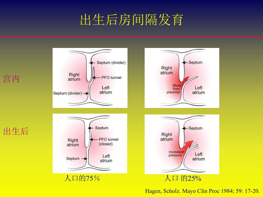 卵圆孔未闭封堵术：争论与发展(中英文)-精品课件.ppt_第3页