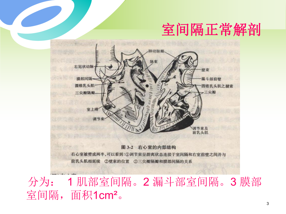 室间隔缺损及相关鉴别的超声诊断(医学PPT课件).ppt_第3页