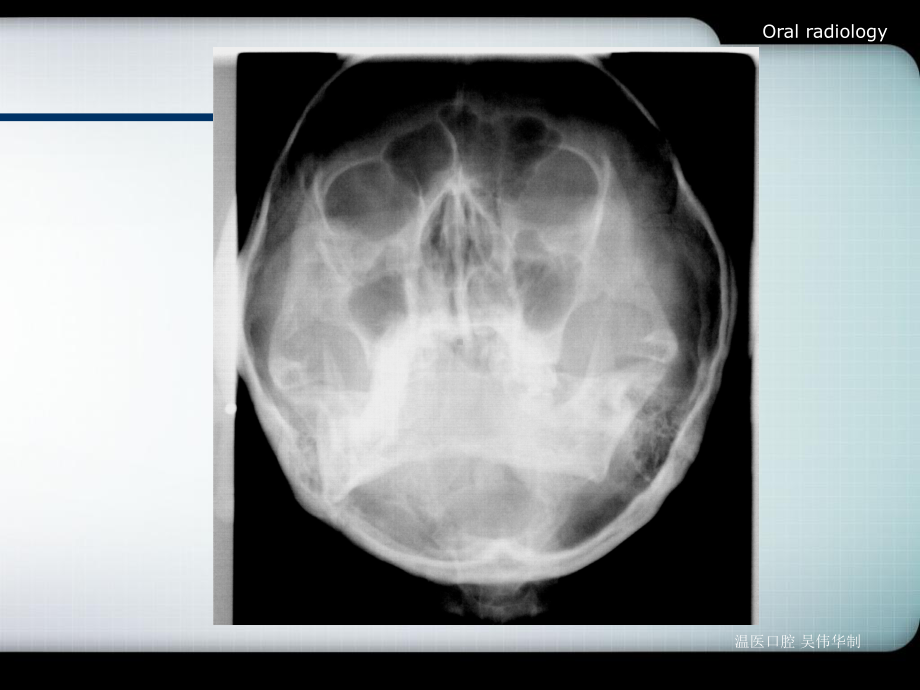 口腔影像诊断学(全)第6章-颌面骨炎症课件.ppt_第3页