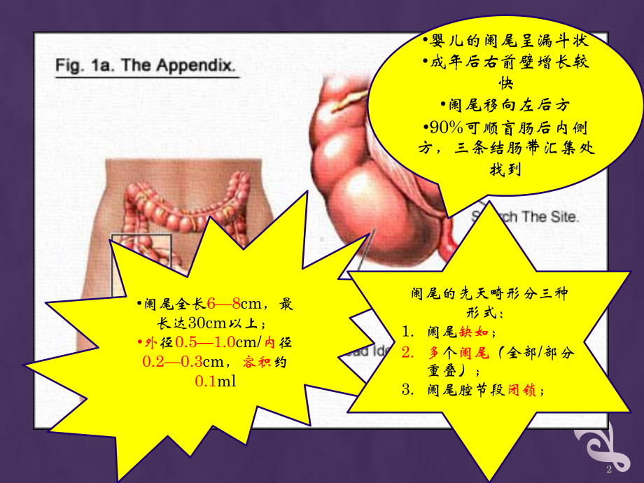 急性阑尾炎医学PPT课件.pptx_第2页