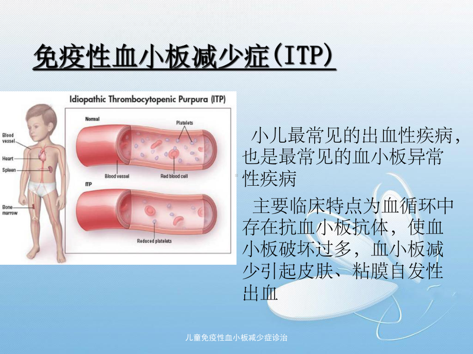 儿童免疫性血小板减少症诊治课件.pptx_第2页