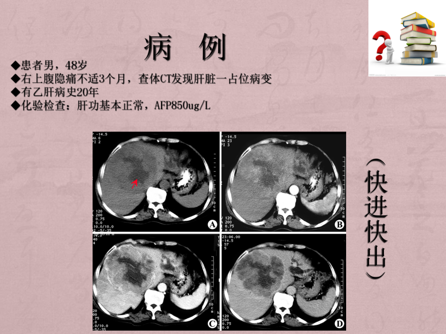 原发性肝癌的诊断课件.ppt_第2页