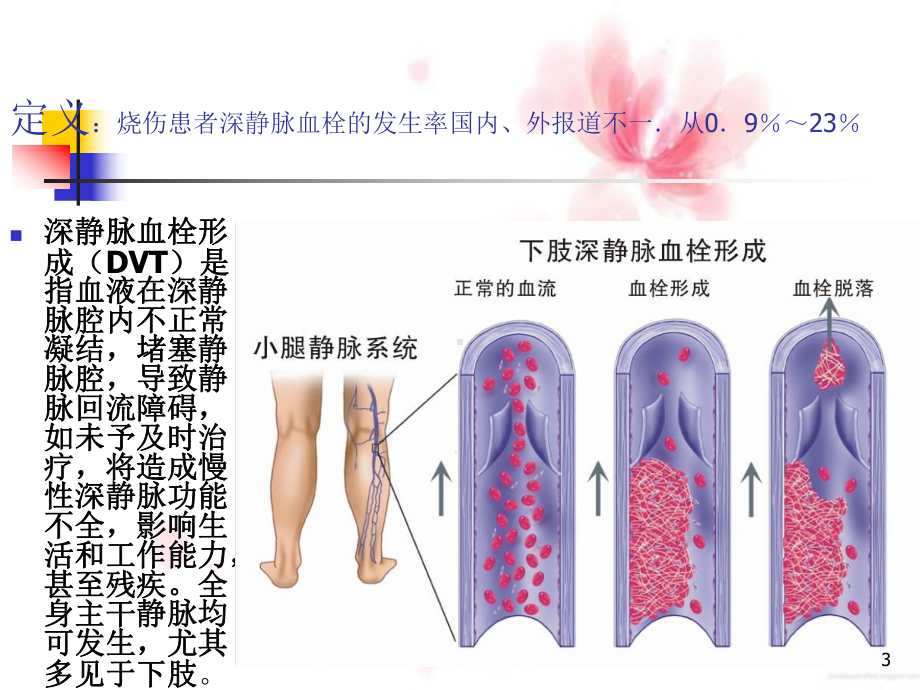 下肢深静脉血栓形成PPT医学课件.pptx_第3页