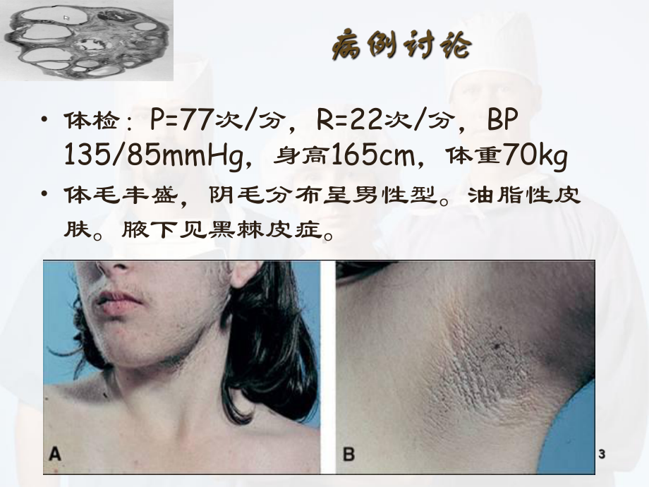 多囊卵巢综合征PPT医学ppt课件.ppt_第3页