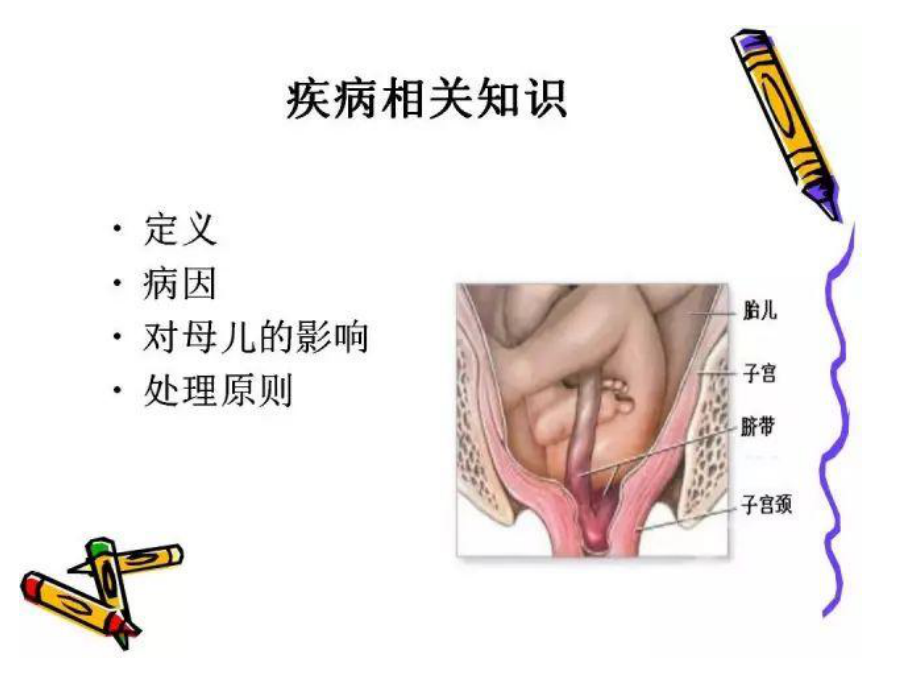 脐带脱垂应急预案(附流程表)PPT.ppt_第3页