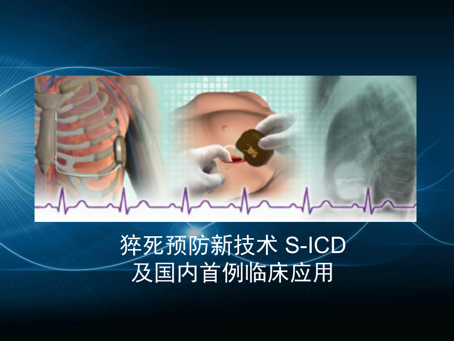 猝死预防新技术-S-ICD及国内首例临床应用课件.pptx_第1页