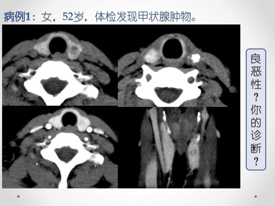 甲状腺癌-叶榕平课件.pptx_第1页