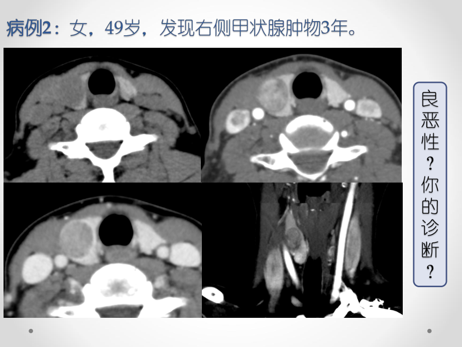 甲状腺癌-叶榕平课件.pptx_第2页