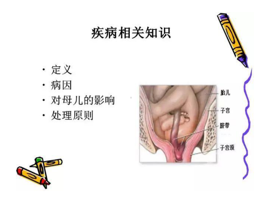 2021年脐带脱垂应急预案PPT.ppt_第3页