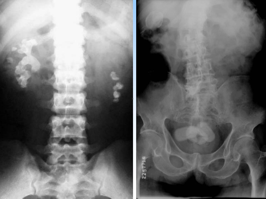 泌尿系统异常影像表现医学PPT课件.ppt_第3页