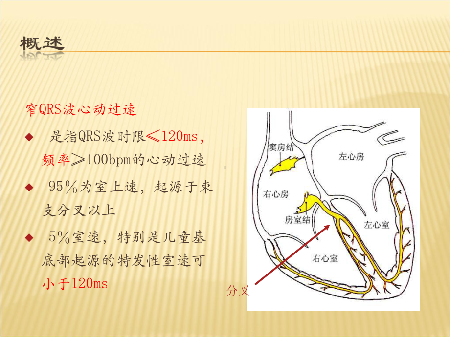 窄QRS波心动过速概述、分类和鉴别诊断课件.ppt_第2页