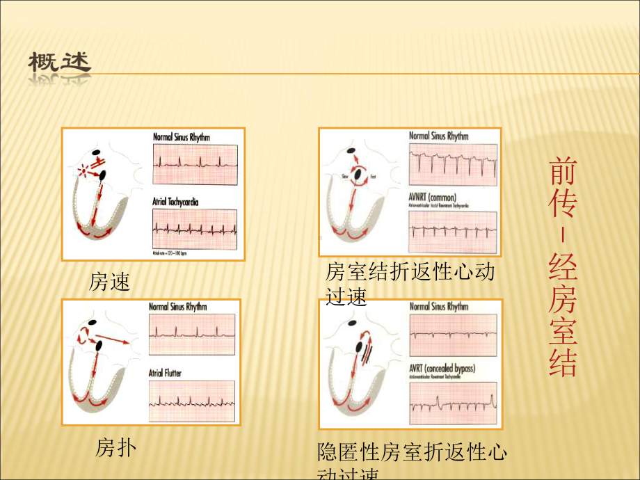 窄QRS波心动过速概述、分类和鉴别诊断课件.ppt_第3页