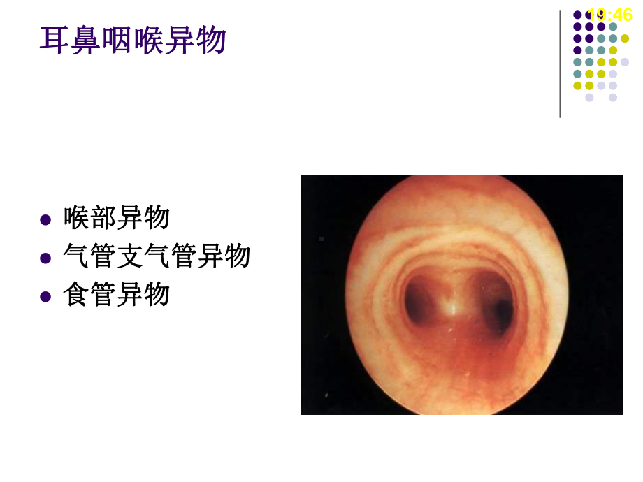 -耳鼻咽喉、食道及气管异物ppt课件.ppt_第2页