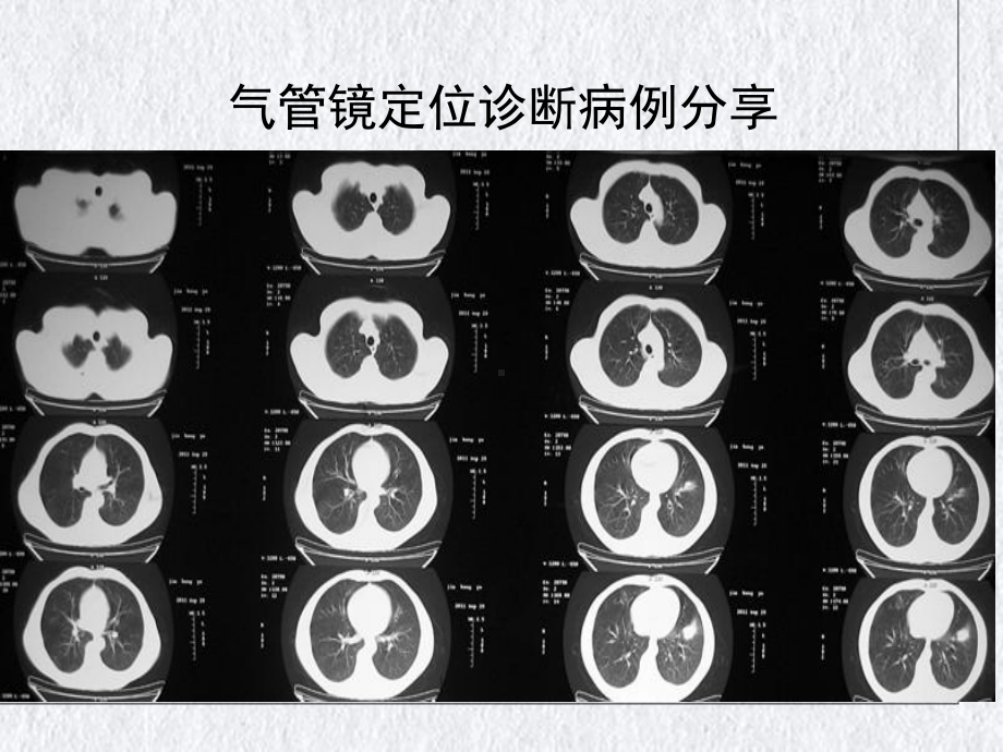 气管镜镜下定位简介授课PPT课件.ppt_第3页