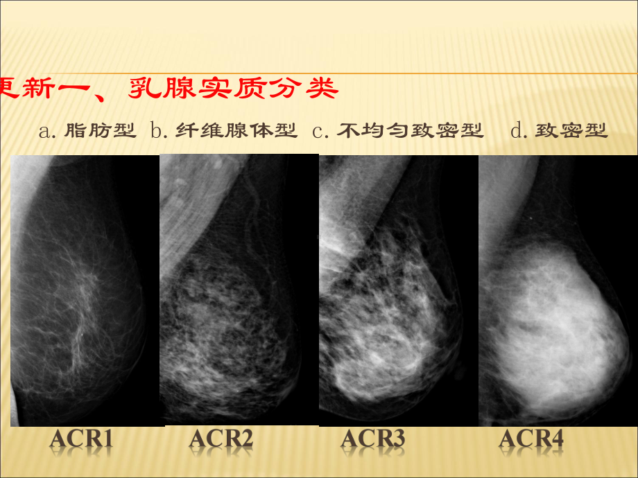 第五版BI-RADS分类更新解读(乳腺钼靶)课件.ppt_第3页