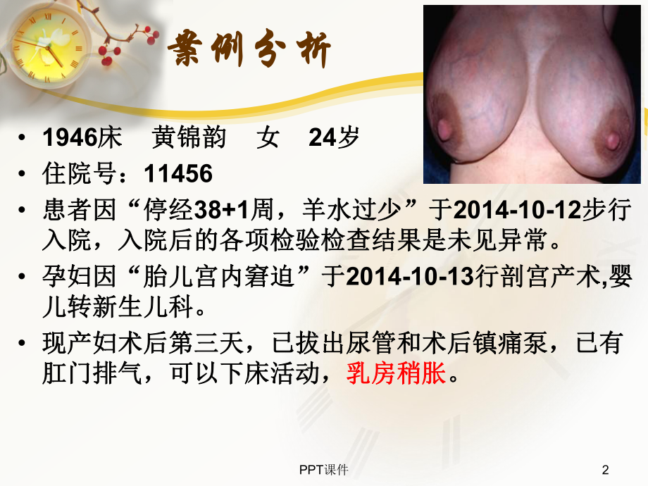 产后乳胀的护理-ppt课件.ppt_第2页