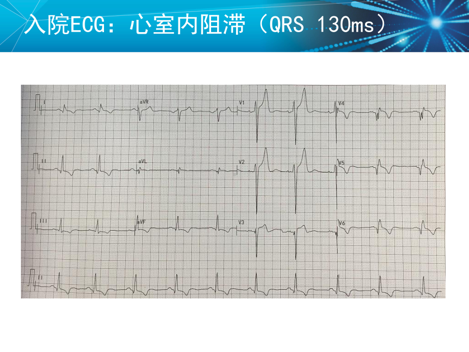 主动固定电极4195应用于永存左上腔植入CRT一例课件.ppt_第3页