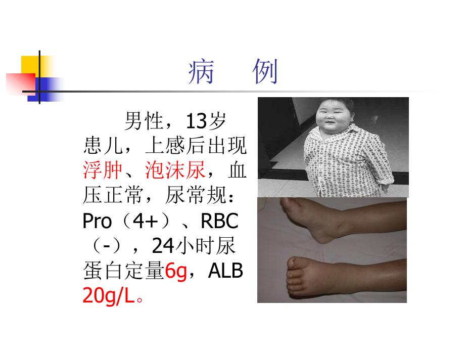 肾病综合征--课件.ppt_第3页