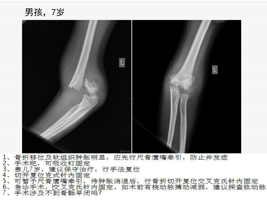 儿童肱骨髁上骨折课件.pptx_第2页