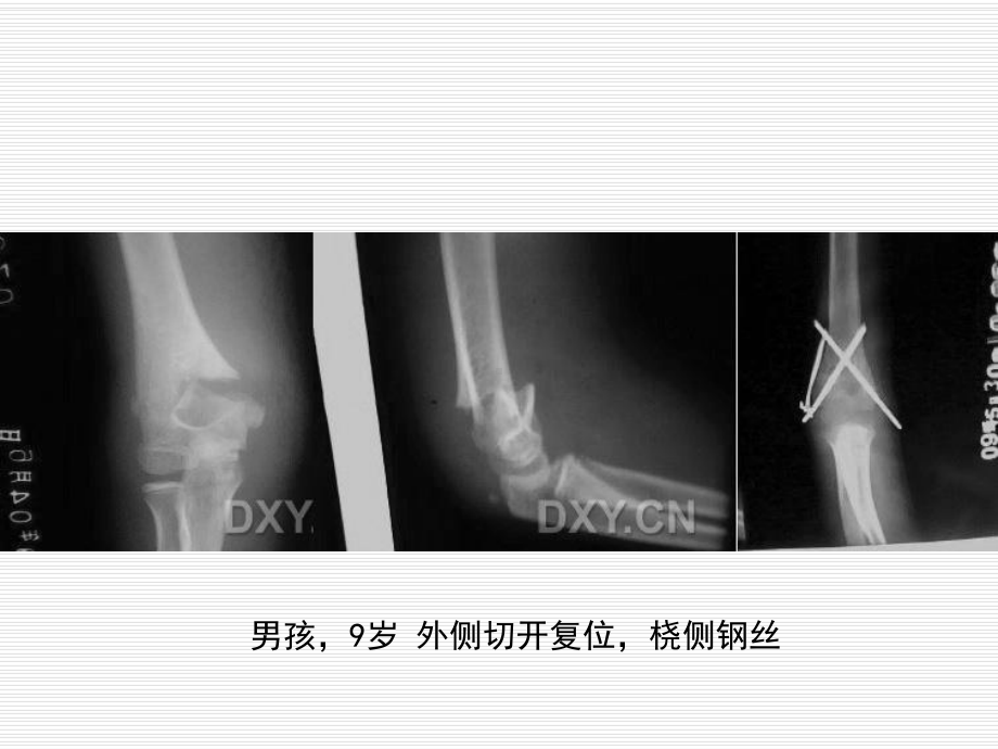 儿童肱骨髁上骨折课件.pptx_第3页