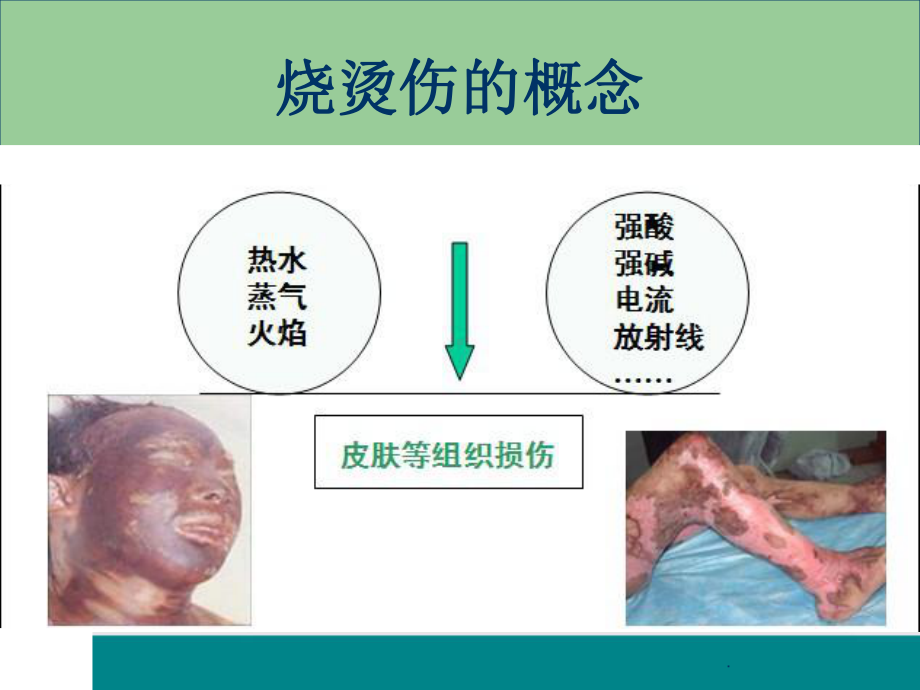 烧烫伤急救处理医学PPT课件.ppt_第2页