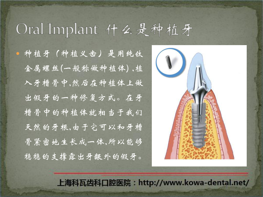 口腔种植学简介-PPT课件.pptx_第3页